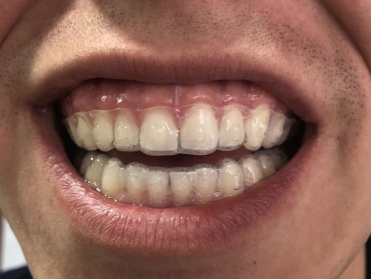 Diferencia entre brackets metálicos y ortodoncia invisible