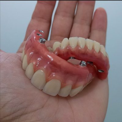¿Sabías que hay diferentes calidades de implantes dentales?