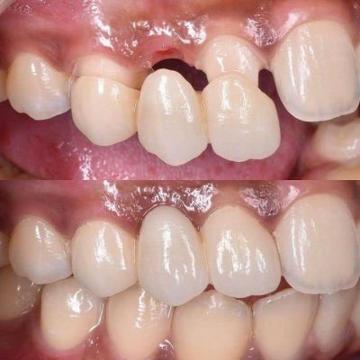 ¿Cuál es la diferencia entre un implante dental y un puente?