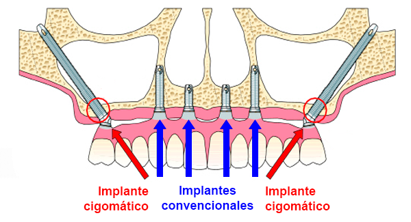implantes cigomaticos