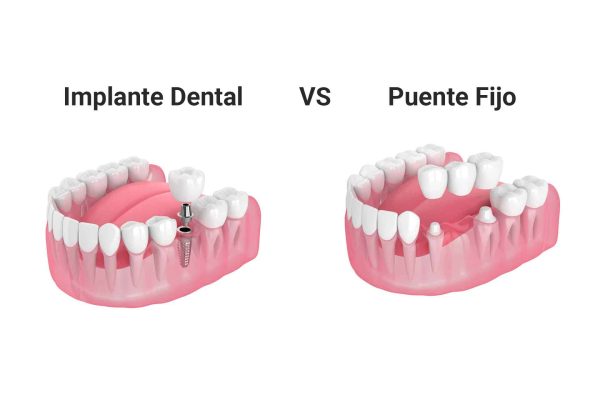 ¿Cuál es la diferencia entre un implante dental y un puente?