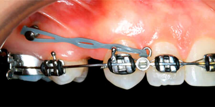 microtornillo de ortodoncia fuenlabrada