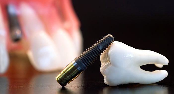 Top 10 de marcas de implantes dentales